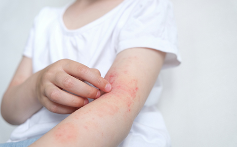 child scratching inflamed arm